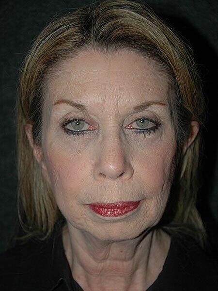 Lip Lift Before & After
