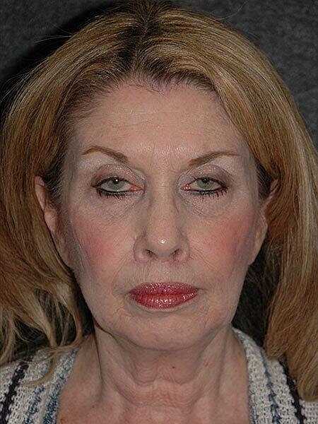 Lip Lift Before & After