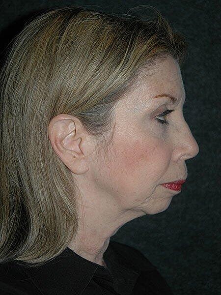 Lip Lift Before & After