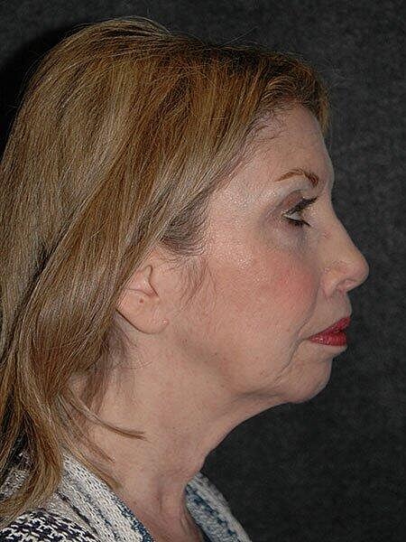 Lip Lift Before & After