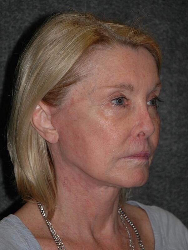 Lip Lift Before & After