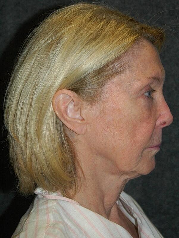 Lip Lift Before & After