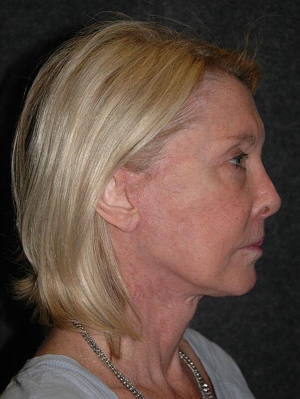 Lip Lift Before & After