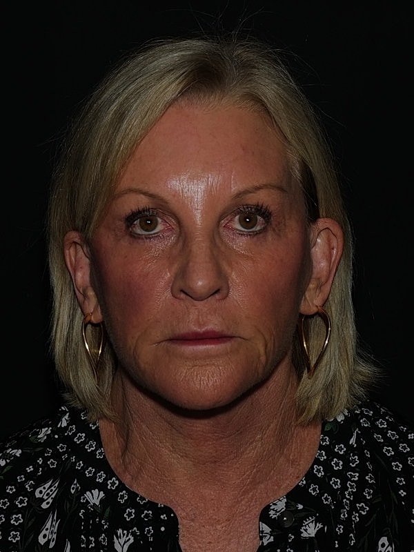 Lip Lift Before & After