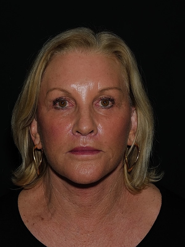 Lip Lift Before & After