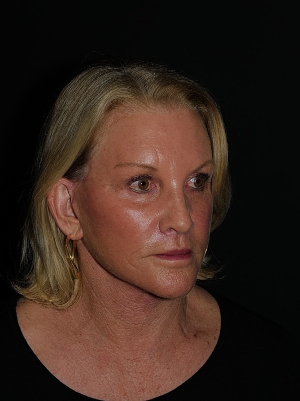 Lip Lift Before & After