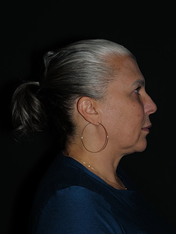 Lip Lift Before & After