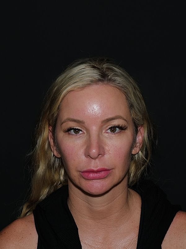 Lip Lift Before & After