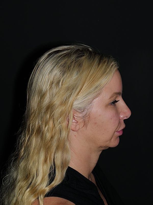 Lip Lift Before & After