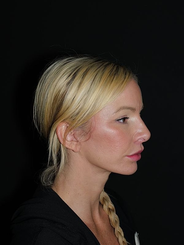 Lip Lift Before & After