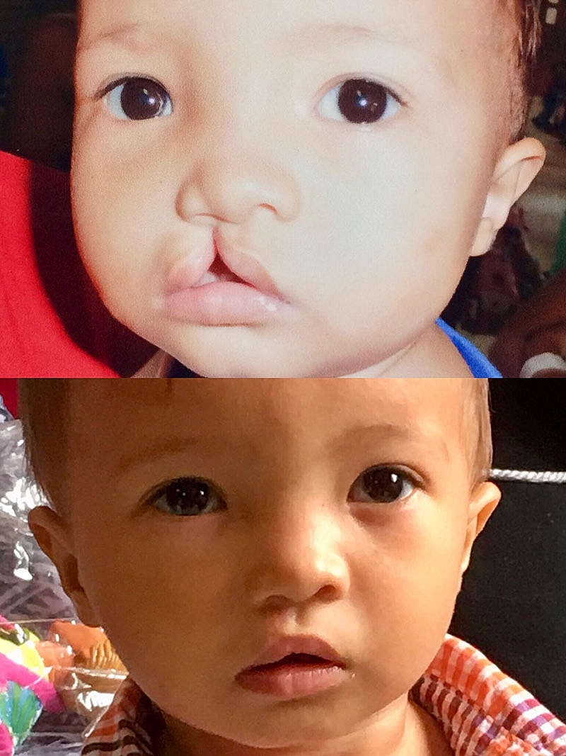 Dr Malone Facial Plastic Surgeon San DiegoBefore and after photos of child with cleft lip.